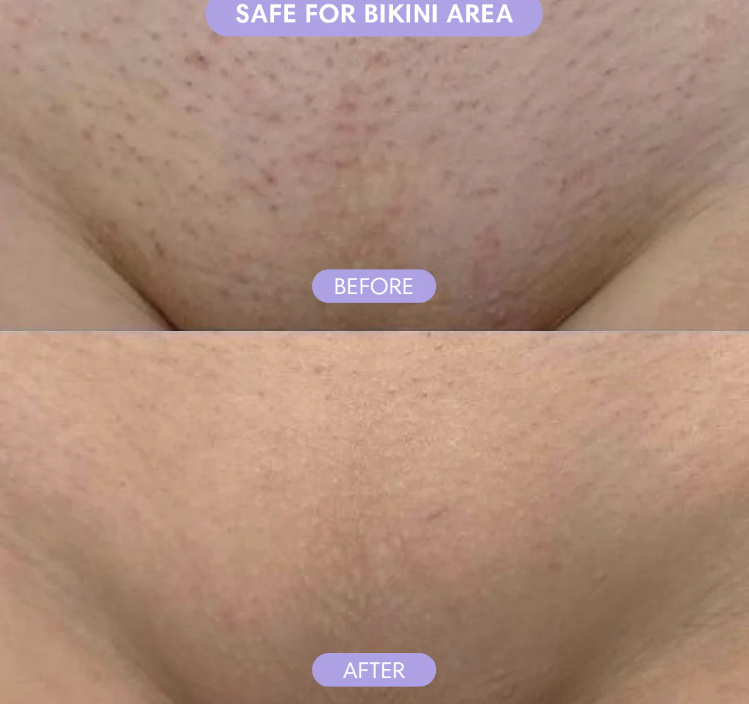 Aureon Crystal Hair Eraser